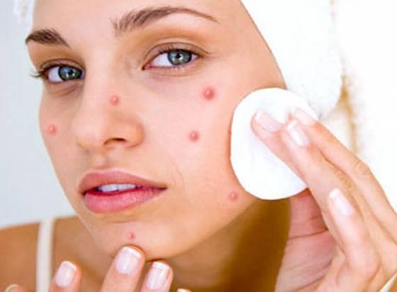 Chăm sóc da mụn trứng cá cao cấp ( buổi lẻ)