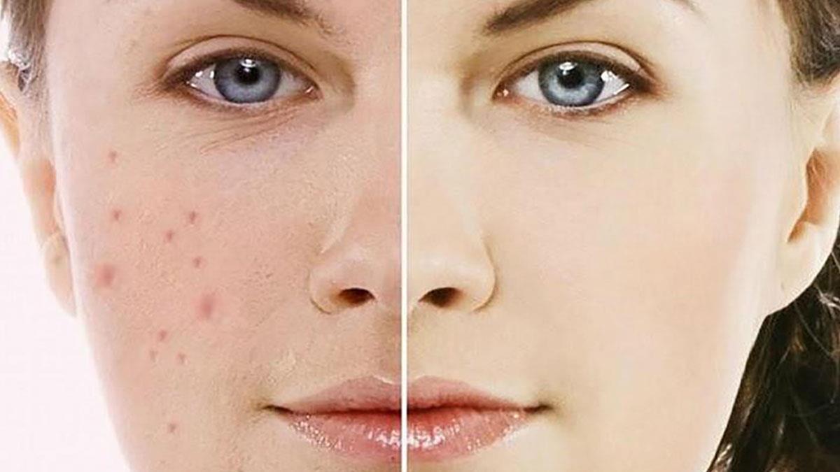 Chăm sóc da mụn trứng cá cao cấp ( 10 buổi )