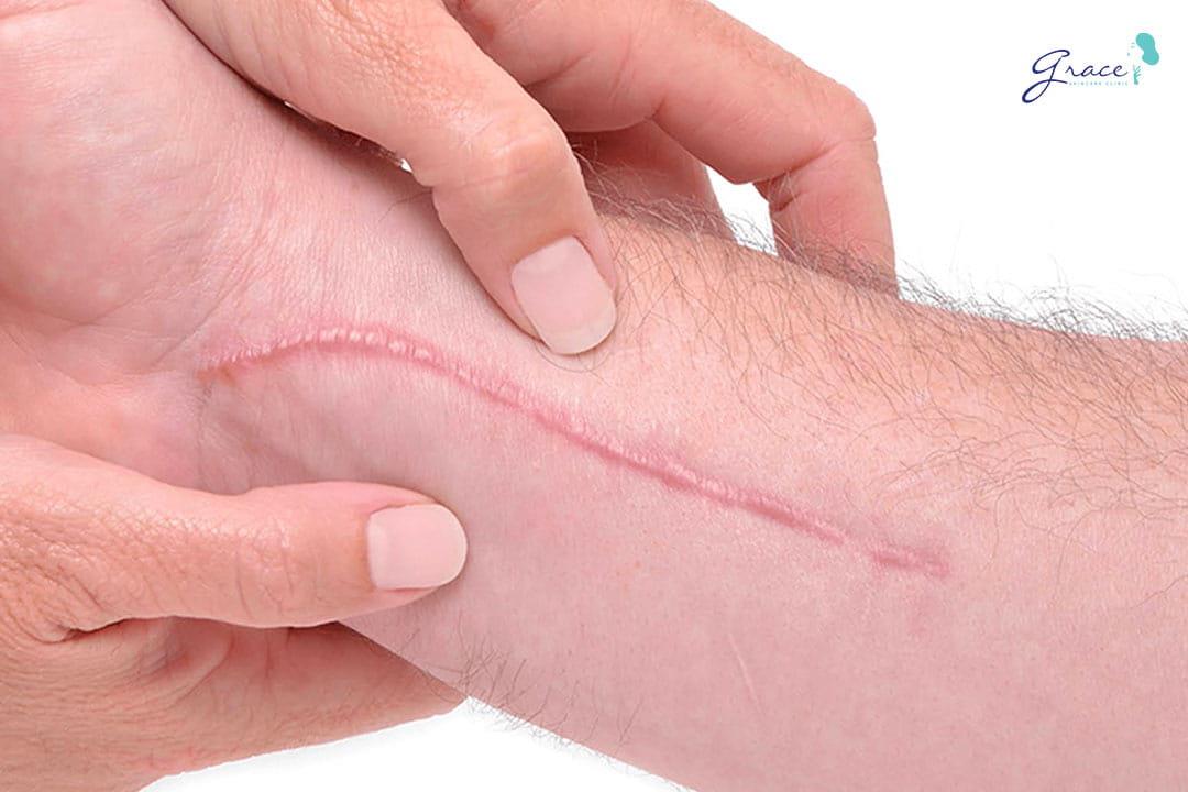 Siêu âm mờ sẹo lồi