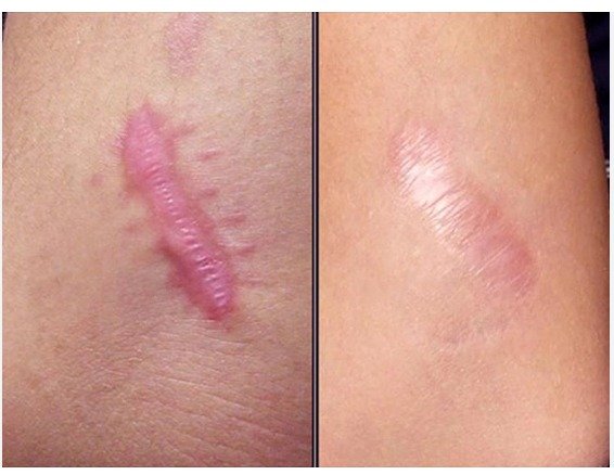 Sẹo lồi 1 lần/ vùng 2cm2