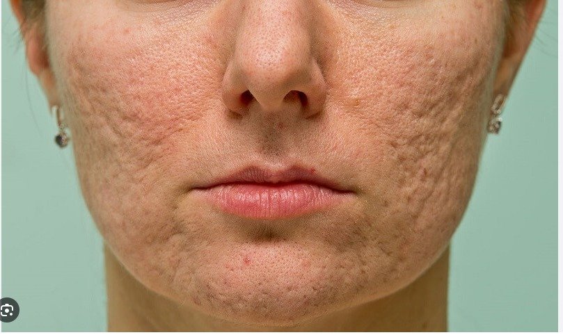 Sẹo lõm mua 6 tặng 1 