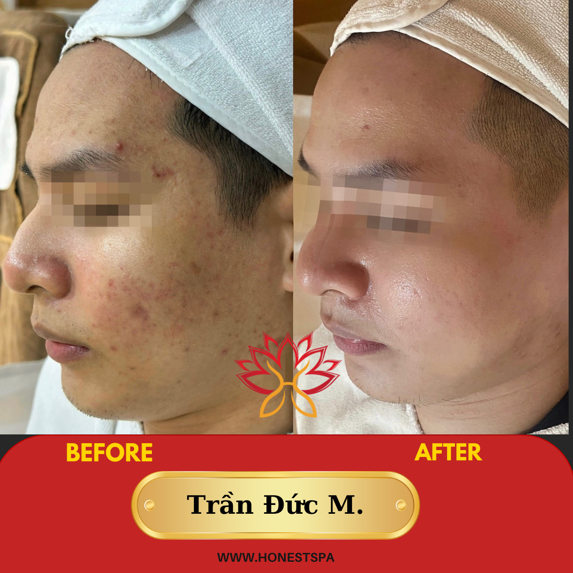 Chăm sóc da mụn trứng cá chuyên nghiệp ( buổi lẻ)