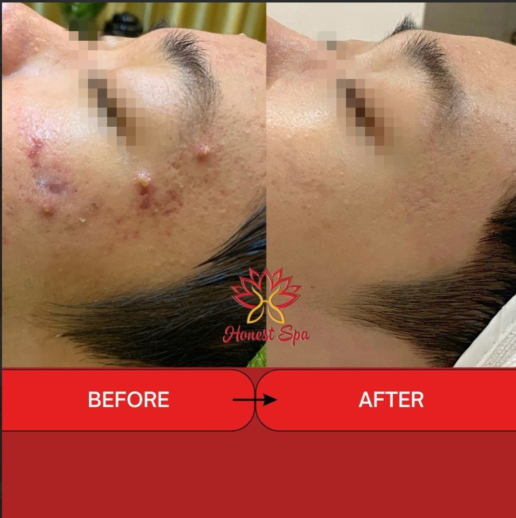 Chăm sóc da mụn trứng cá chuyên nghiệp (mua 10 tặng 2)