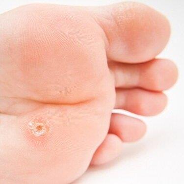 Điều trị dứt điểm Mụn Cóc 