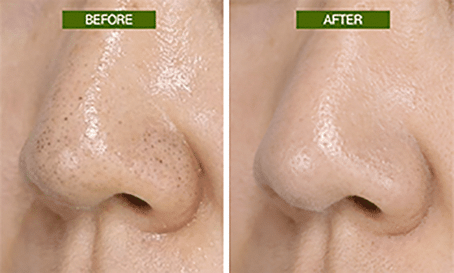 Peel Mụn đầu đen vùng mũi 