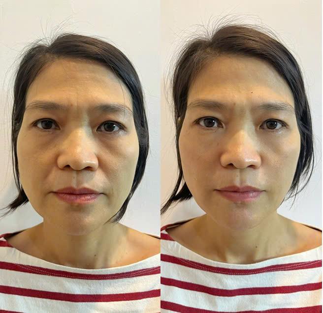 Trẻ hoá đa tầng 