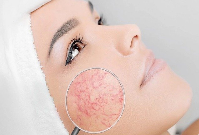 Meso phục hồi da bệnh lý Tranacix