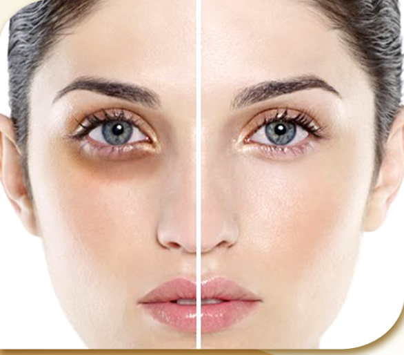 Meso dưỡng mắt - Tây Ban Nha 