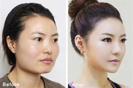 Nâng cơ cười - Hàn Quốc